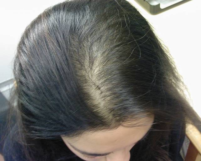 chute de cheveux femme