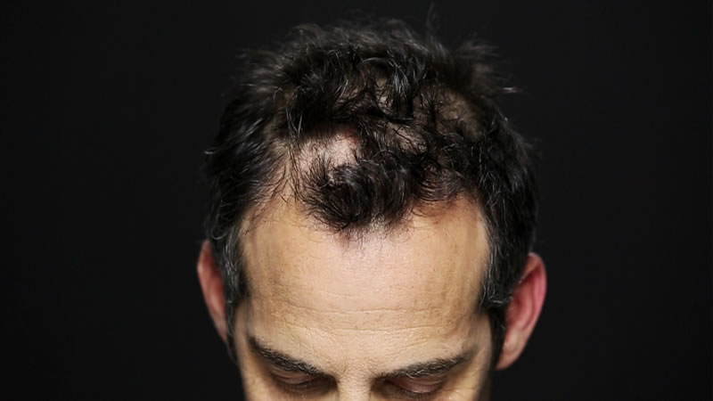 avant-après toppik