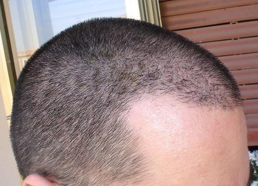 Diffuser Haarausfall