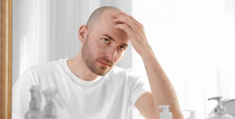 Die verschiedenen Ursachen von Haarausfall